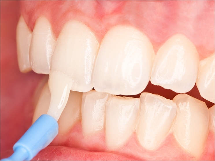  fluoride varnish minerals oral care walla walla dental care dr. gantz college place dentist