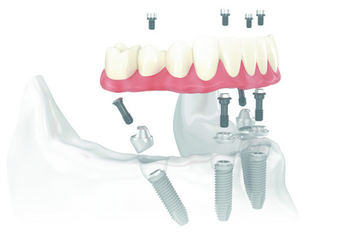 Diagram of All-on-4 Implants treatment at Timothy H. Kindt, DDS