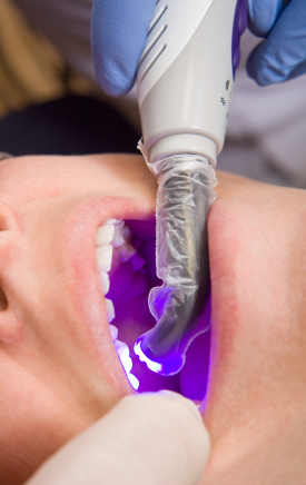 What Are The Benefits Of Getting Fillings?