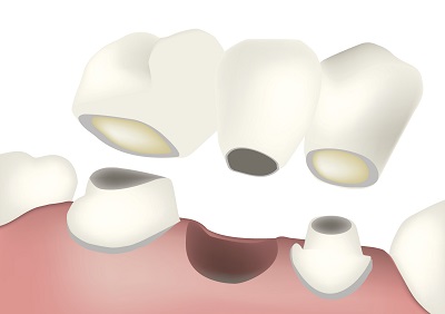 Diagram of a dental bridge from dentist office in Mesa, AZ. Diagram of a dental bridge from dentist office in Mesa, AZ.