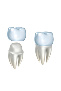 Dental Crowns at Neu Family Dental
