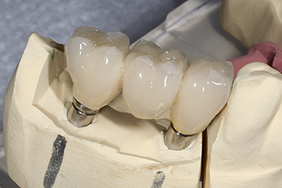 A porcelain model of a bridge by Owasso dentist from Jillian Prather Family Dentistry.