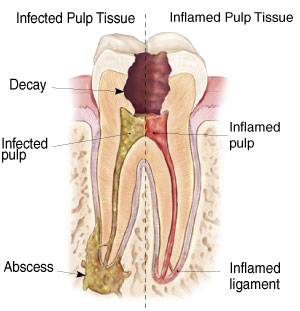 Cross section of the tooth with infected and inflamed tissue at Neu Family Dental