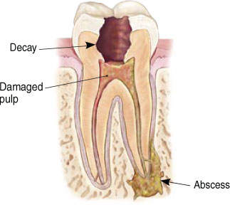 A diagram of a an abscessed tooth Hillsboro, OR A diagram of a an abscessed tooth Hillsboro, OR