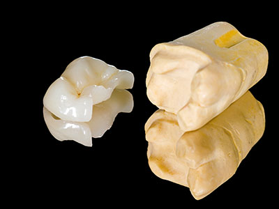 Inlay and Onlays against a black background at Neu Family Dental