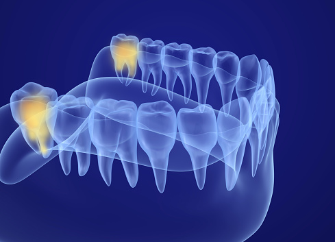 Photograph of a wisdom teeth from at Cooley Smiles in Everett, WA