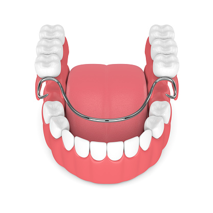 Diagram of removable partial dentures from Cooley Smiles in Everett, WA