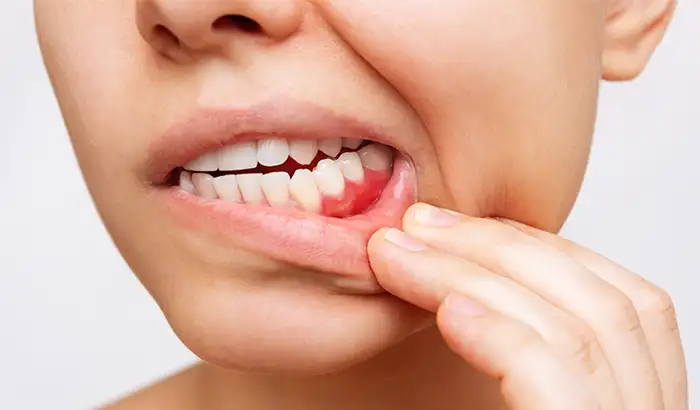 Close up of woman’s mouth and her hand pulling down her bottom lip to reveal puffy gums before gum disease treatment at Cooley Smiles in Everett, WA