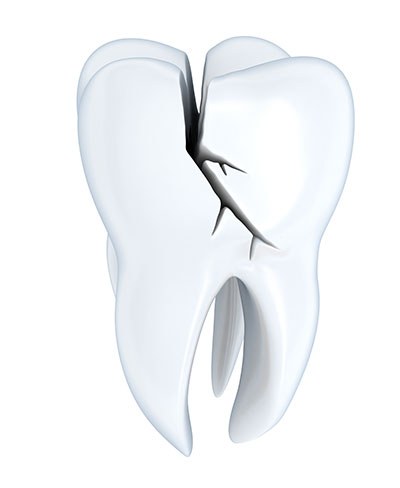 Single tooth replacement with dental implants at Neu Family Dental