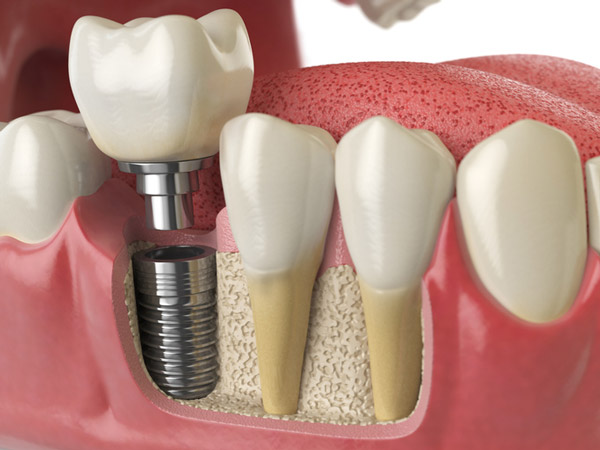 3D-rendered cross-section of a dental implant placed in to jaw bone 3D-rendered cross-section of a dental implant placed in to jaw bone