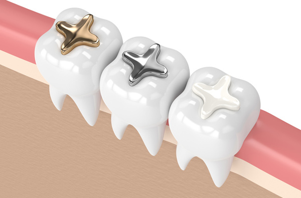 Rendering of teeth with 3 dental filling materials from Hoffman Dental in Hillsboro, OR