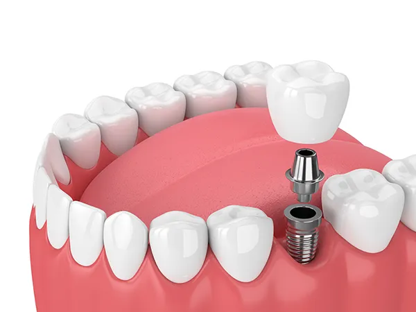 3D rendering of a dental implant and its components (screw, abutment, and crown) being placed into the jaw at Timothy H. Kindt, DDS in MesaAZ 