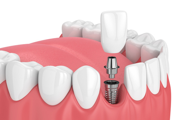 Rendering of jaw with dental implant at Jillian Prather Family Dentistry in Owasso, OK
