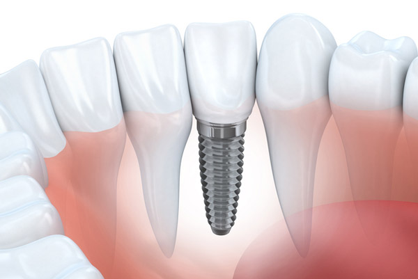 Diagram of dental implant in lower jaw from Jillian Prather Family Dentistry in Owasso, OK