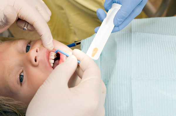 Young boy receiving fluoride treatment at Hoffman Dental in Hillsboro, OR