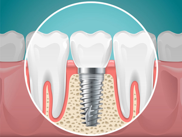 Diagram of a tooth replaced with a dental implant from Jillian Prather Family Dentistry in Owasso, OK