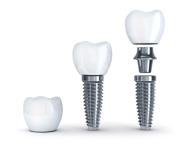 Diagram of dental implant with post from Cooley Smiles in Everett, WA
