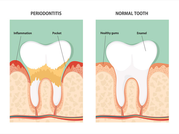 Diagram of tooth before and after periodontal therapy, tooth on the left has periodontitis and healthy tooth is on the right from Jillian Prather Family Dentistry in Owasso, OK