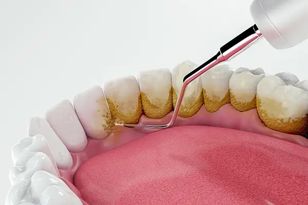 Close up 3D rendering of dirty teeth being cleaned and restored by a dental tool at Cooley Smiles in Everett, WA