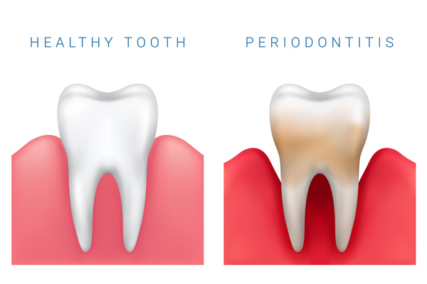 Photograph of a healthy tooth and a periodontitis tooth  from Cooley Smiles in Everett, WA