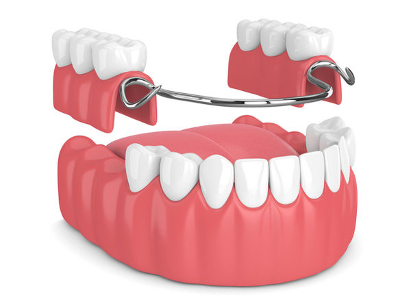 Rendering of removable partial denture from Cooley Smiles in Everett, WA