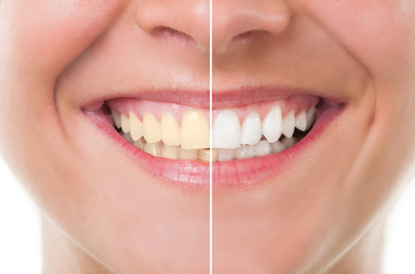 Before and after photo of teeth whitening treatment from Cooley Smiles in Everett, WA
