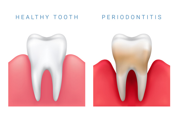 Diagram of healthy tooth compared to periodontitis diseased tooth at Timothy H. Kindt, DDS in Mesa, AZ