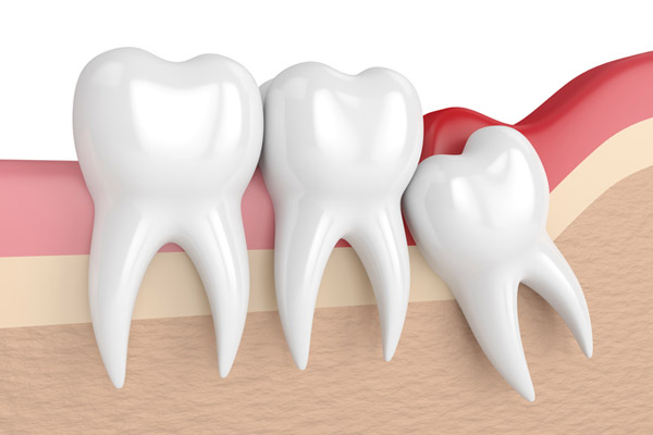 A rendering of a wisdom tooth in need of extracting illustrated by Hoffman Dental in Hillsboro, OR