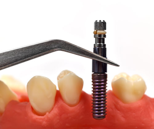 graphic illustraction of a dental implant post that has achieved osseointegration at Timothy H. Kindt, DDS in Mesa, AZ