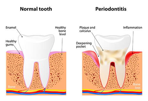 Gum Disease diagram at Timothy H. Kindt, DDS. Gum Disease diagram at Timothy H. Kindt, DDS.