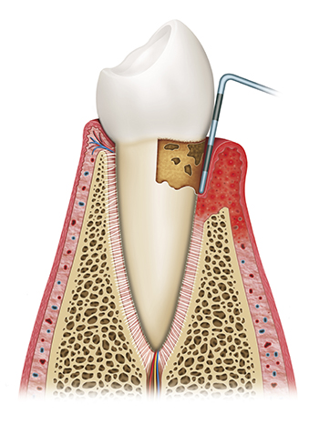 Scaling and root planning  at Neu Family Dental, in East Dundee, IL