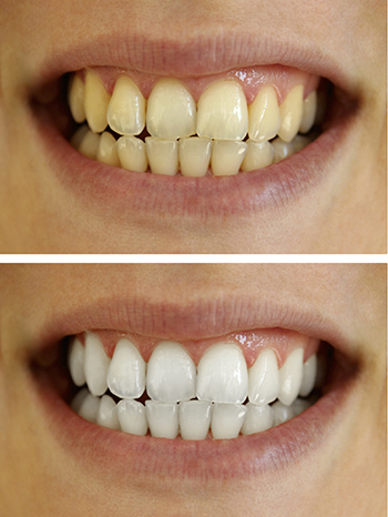 Before and after teeth whitening images at Timothy H. Kindt, DDS in Mesa, AZ Before and after teeth whitening images at Timothy H. Kindt, DDS in Mesa, AZ