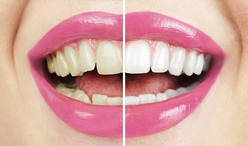 A smile before and after teeth whitening at Hoffman Dental in Hillsboro, OR