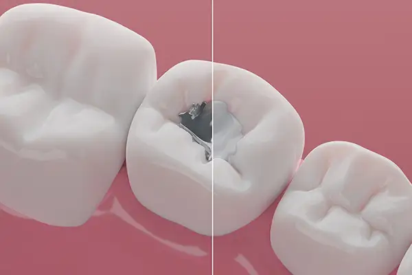 Before and after three teeth on a gumline where one tooth has a cracked filling that has been repaired.