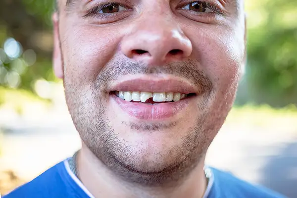 Smiling man outdoors showing a front tooth with a large chip, emphasizing the need for dental care at Hoffman Dental in Hillsboro, OR