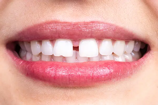 Close-up of a woman's smile with a visible chipped front tooth at Hoffman Dental in Hillsboro, OR Close-up of a woman's smile with a visible chipped front tooth at Hoffman Dental in Hillsboro, OR