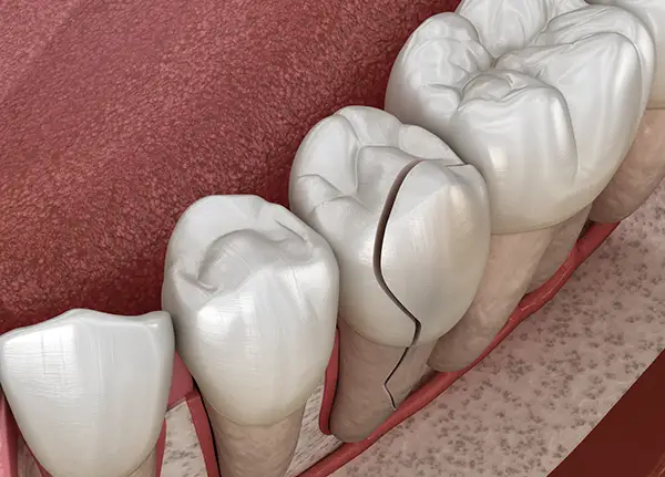 Close-up of a cracked molar tooth in the lower jaw illustrated by Hoffman Dental in Hillsboro, OR
