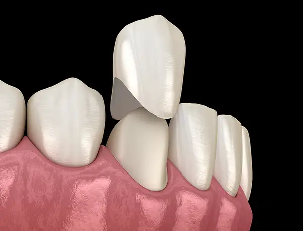 A dental crown being placed on a front tooth, highlighting the precise fit and restoration process at Hoffman Dental in Hillsboro, OR