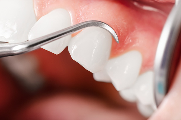 A Close up of healthy gums and white teeth at Cooley Smiles in Everett, WA