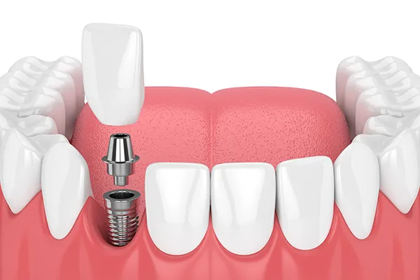 A front tooth dental implant, showing the implant post, abutment, and crown being assembled in the upper jaw, illustrated by Hoffman Dental in Hillsboro, OR
