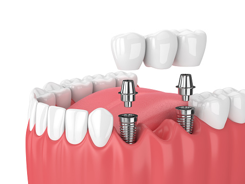 A rendering of an implant supported bridge at Cooley Smiles in Everett, WA